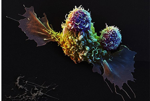 Как раковую опухоль атакуют CAR T-клетки: ФОТО увеличены в 2000 раз